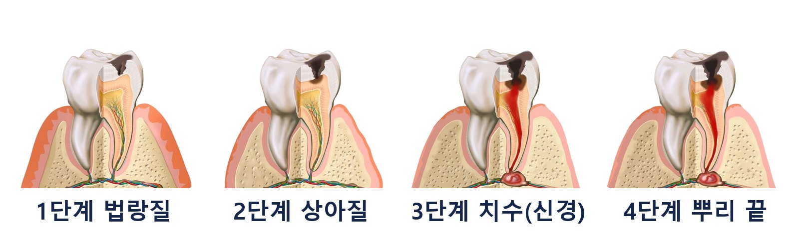 충치 진행 4단계: 법랑질, 상아질, 치수, 뿌리 끝까지 번진 상태