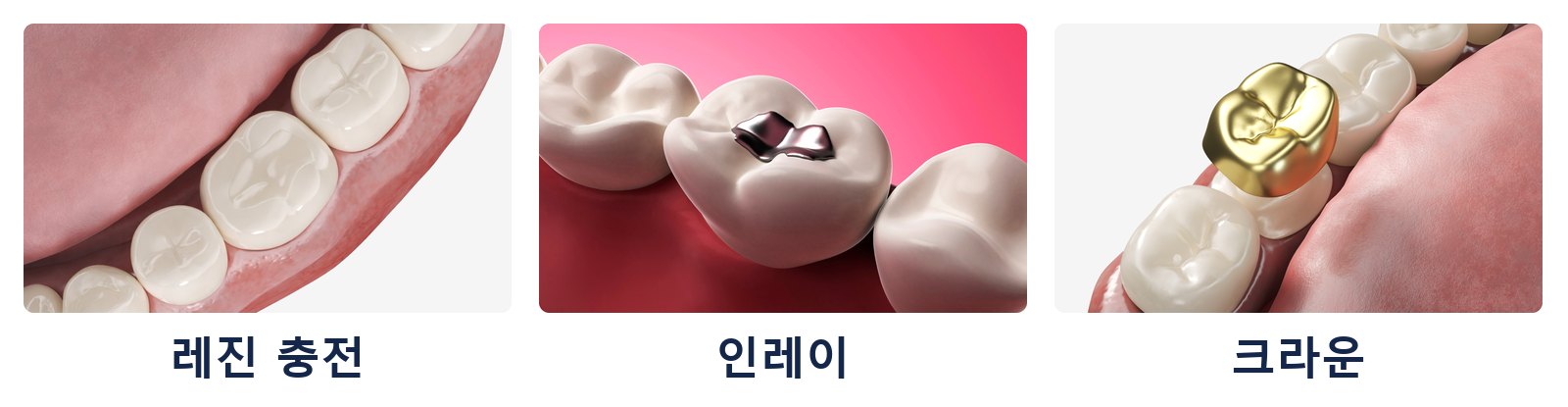 충치 수복 3종: 레진 충전, 인레이, 크라운. 범위와 남은 치아의 양에 따라 단계가 정해집니다