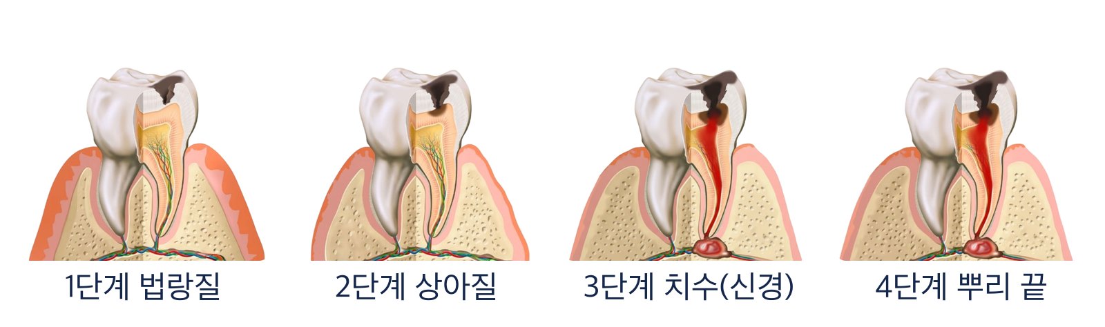 충치 진행 4단계 그림. 법랑질, 상아질, 치수를 거쳐 뿌리 끝까지 진행하면 뿌리 끝 주변 뼈에 염증이 생깁니다