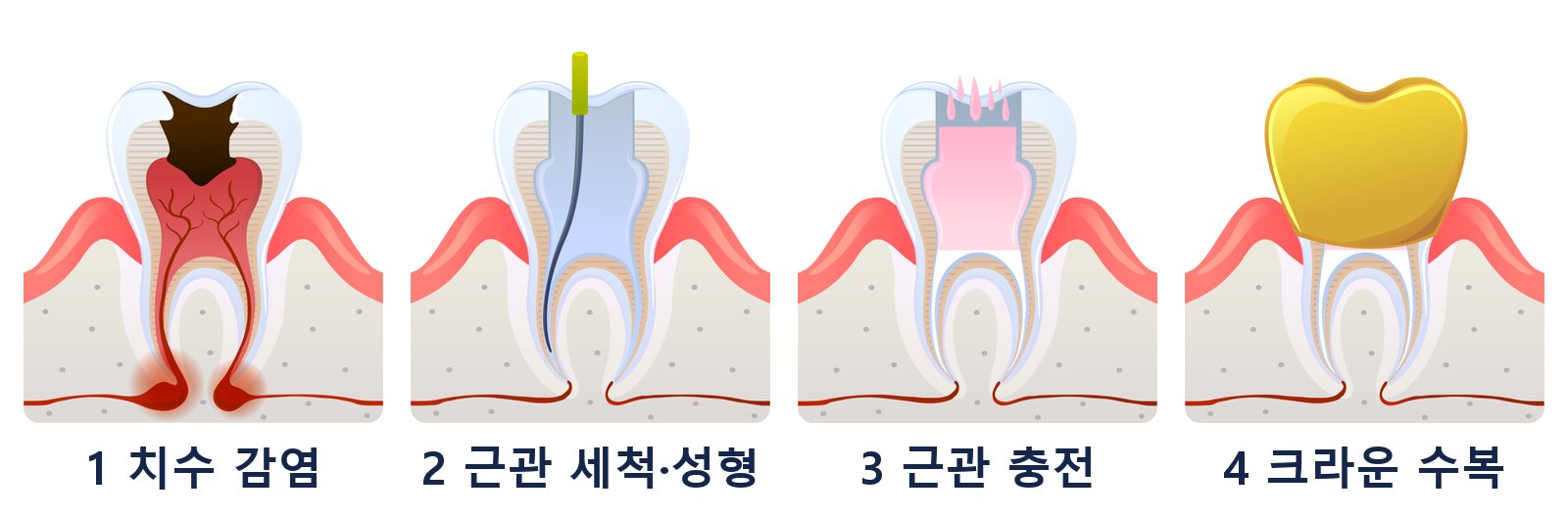 신경치료 4단계: 치수 감염, 근관 세척·성형, 근관 충전, 크라운 수복. 보존 치료는 이 순서로 치아를 남깁니다