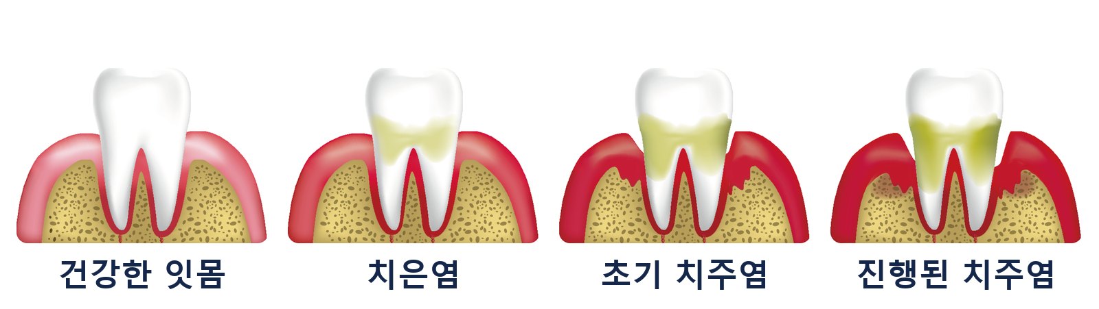 잇몸 질환 4단계: 건강한 잇몸, 치은염, 초기 치주염, 진행된 치주염. 내 잇몸이 어느 단계인지 설명받는 것이 상담의 출발점입니다
