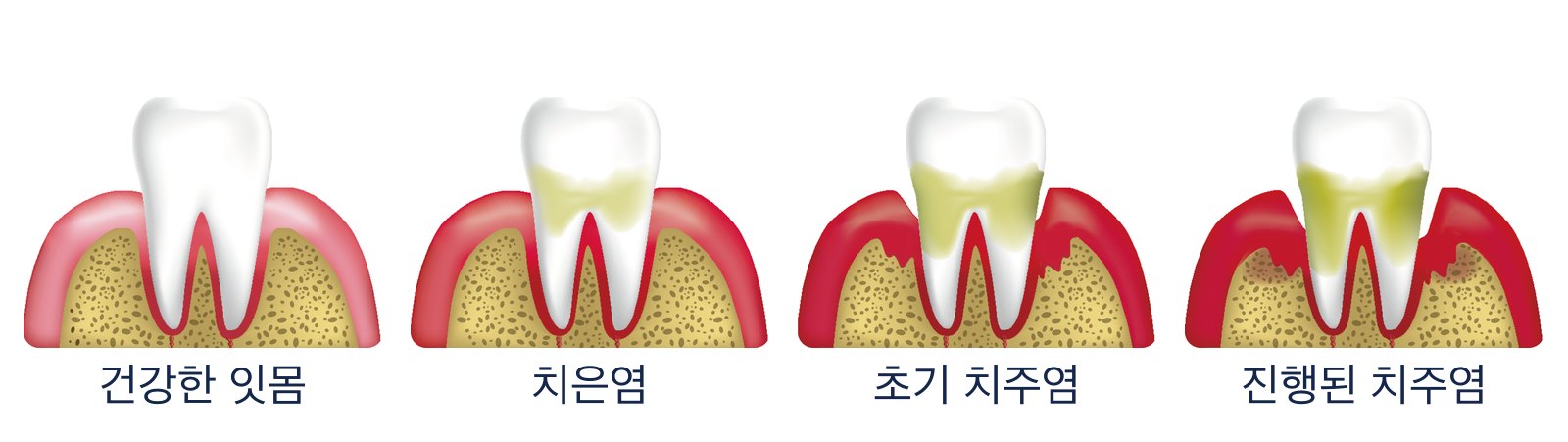 잇몸 질환 4단계: 건강한 잇몸, 치은염, 초기 치주염, 진행된 치주염. 단계가 진행할수록 잇몸 아래 치석과 뼈 소실이 커집니다