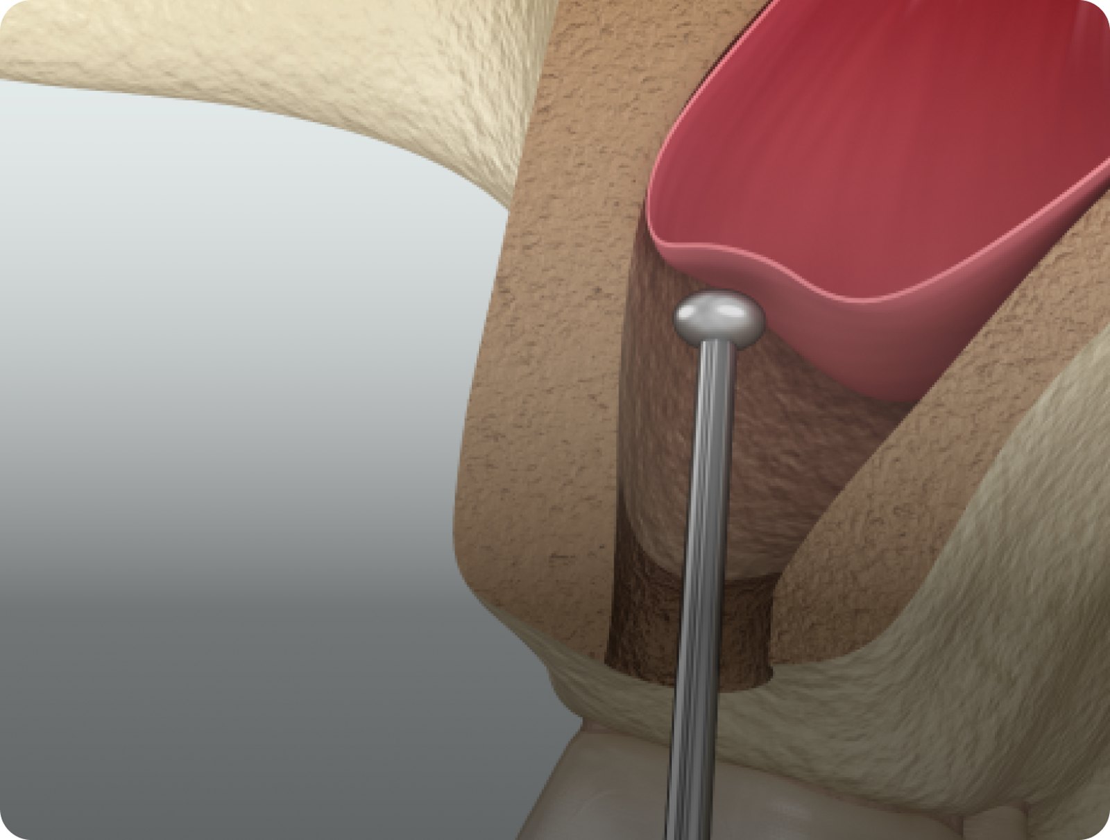 위턱 어금니 부위에서 상악동 바닥을 들어 올리고 이식재를 채우는 그림. 잔존골이 낮을 때 식립 높이를 만드는 술식입니다