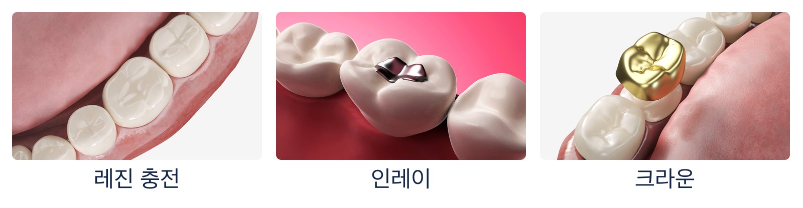 충치 수복 3종 그림. 왼쪽부터 레진 충전, 인레이, 크라운 순으로 덮는 범위가 넓어집니다