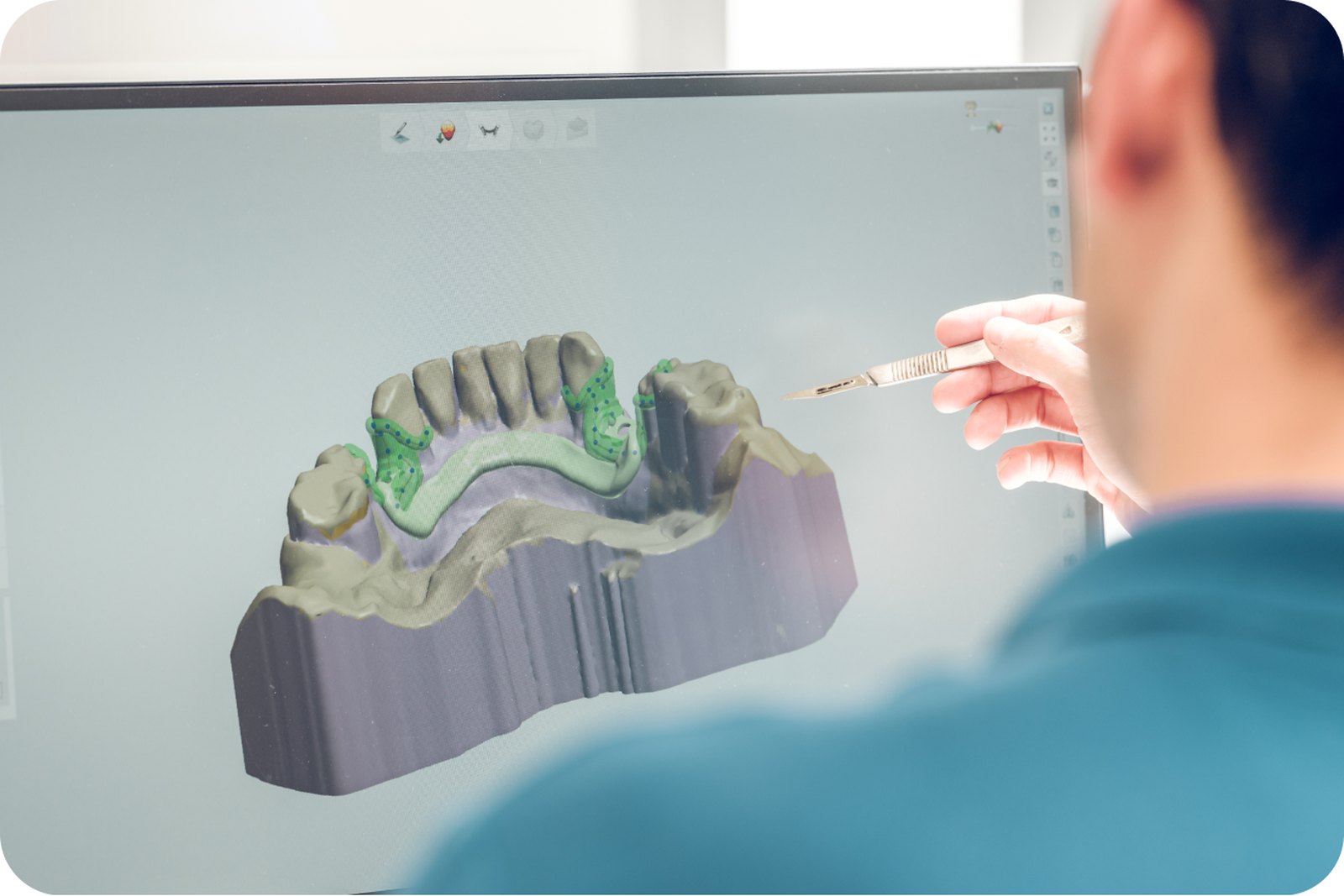 구강스캐너로 만든 치아 3D 모델 화면. 설계 단계에서 이런 자료로 결과 형태를 미리 확인합니다