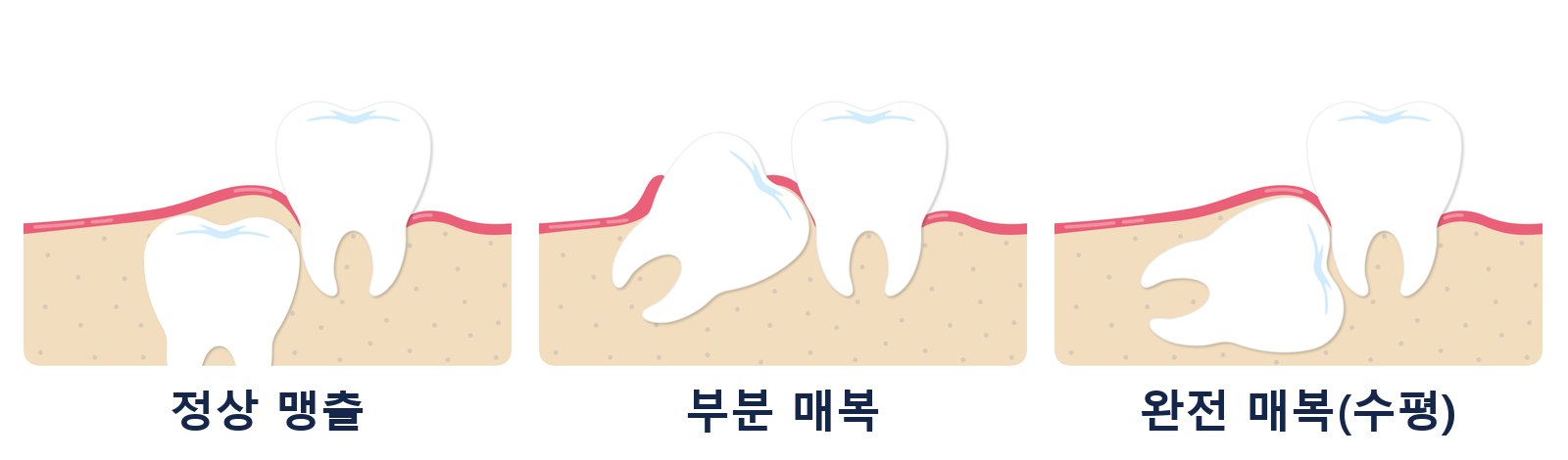 사랑니 맹출 형태 3가지: 정상 맹출, 잇몸에 일부 덮인 부분 매복, 뼈 속에 묻힌 완전 매복