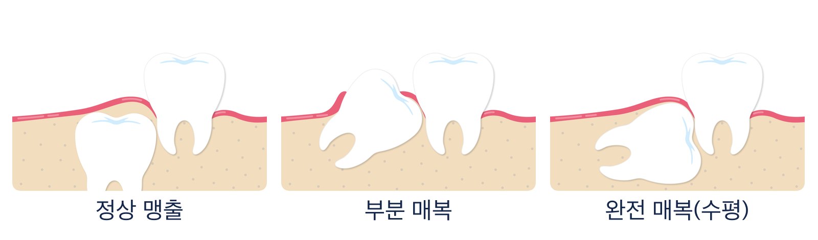 사랑니 맹출 형태 세 가지(정상 맹출, 부분 매복, 완전 매복). 잇몸에 반쯤 덮인 부분 매복이 염증과 통증이 잘 생기는 형태입니다